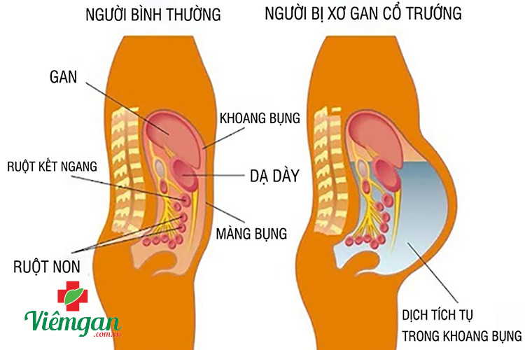 Xơ gan cổ trướng có chữa được không? 1