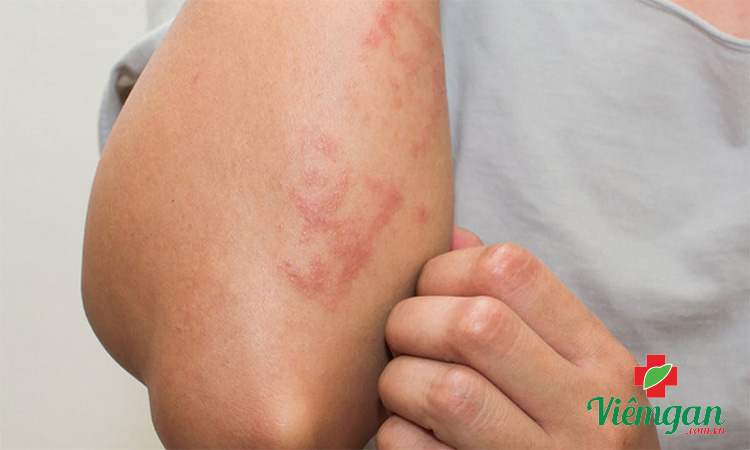 Dị ứng với thành phần trong Cà gai leo 1