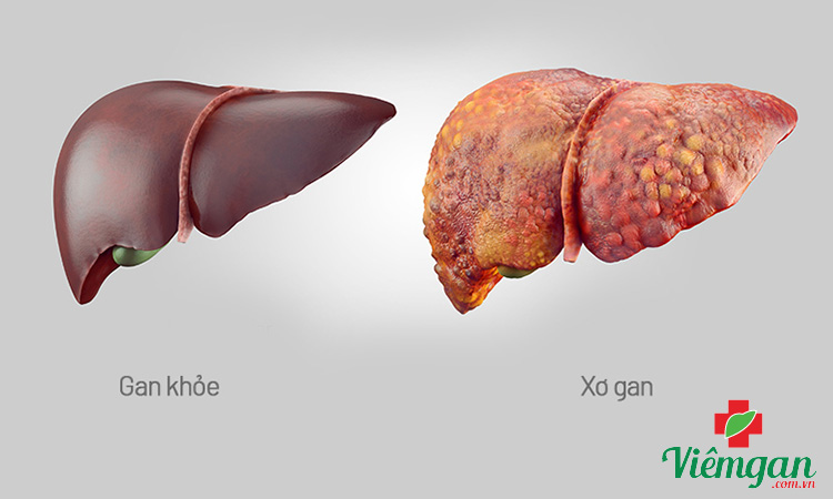 Vì sao cần có kế hoạch chăm sóc bệnh nhân xơ gan? 1