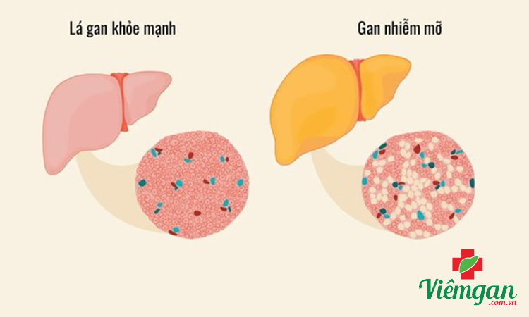 Dấu hiệu xơ gan do rượu 1