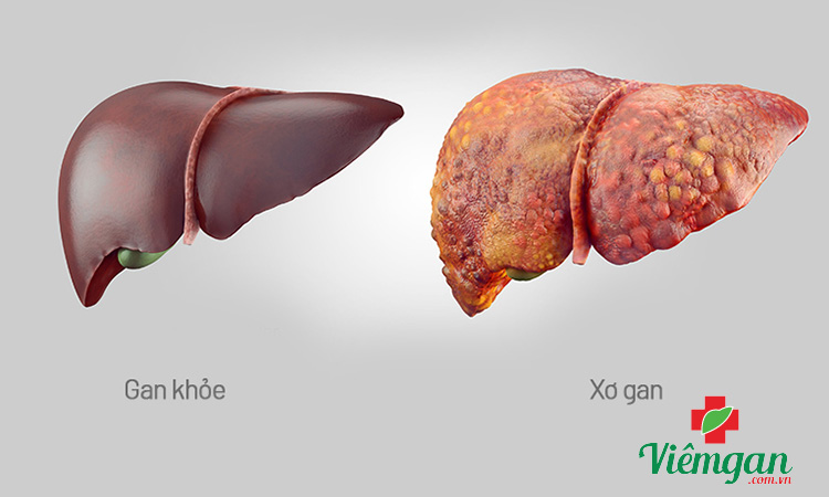 Xơ gan cực nguy hiểm nếu không điều trị sớm 1