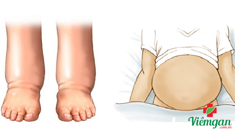 Chăm sóc giảm nhẹ phù và cổ trướng 1