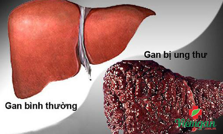 Điều trị biến chứng 3 Điều trị biến chứng 3