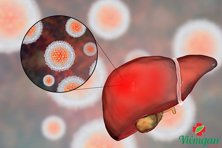 Hỗ trợ điều trị viêm gan virus 1