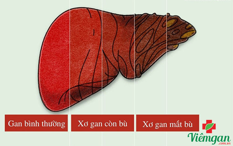 Nguyên nhân dẫn tới xơ gan mất bù 1