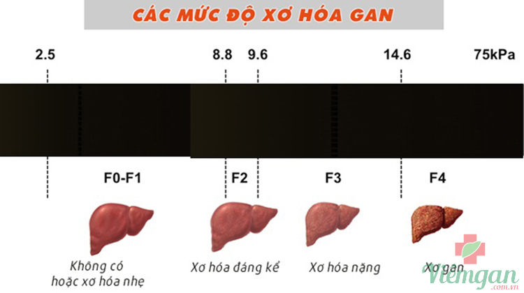 Phân độ xơ gan theo Metavir 1