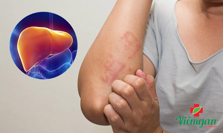 Uống thuốc giải độc gan bị ngứa do đâu? 1 Uống thuốc giải độc gan bị ngứa do đâu? 1