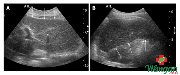 Hình ảnh siêu âm xơ gan 1 Hình ảnh siêu âm xơ gan 1