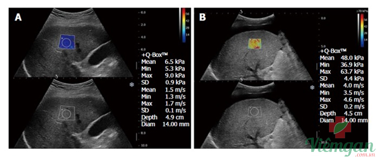 Hình ảnh siêu âm xơ gan 3 Hình ảnh siêu âm xơ gan 3
