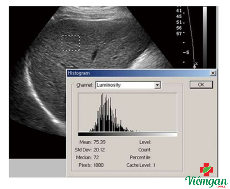 Hình ảnh siêu âm xơ gan 2 Hình ảnh siêu âm xơ gan 2