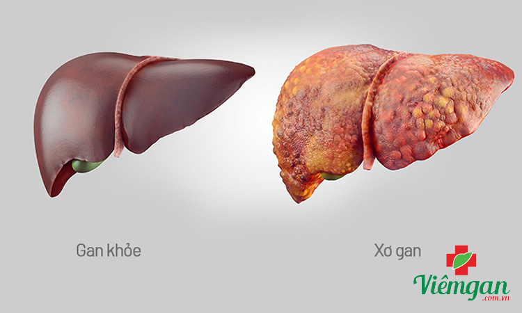 Xơ gan là gì? 1 Xơ gan là gì? 1