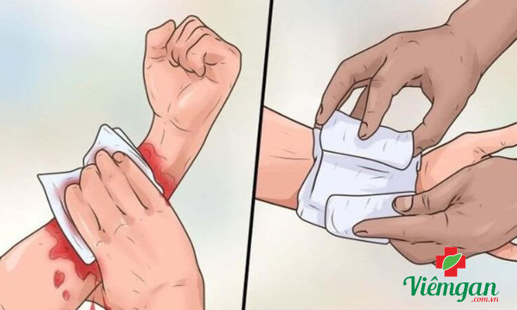 Triệu chứng viêm gan B mạn tính 1