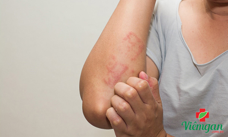 Triệu chứng viêm gan B kéo dài bao lâu? 1