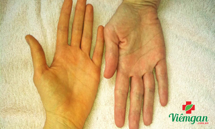 3. Bài thuốc trị can nhiệt tỳ thấp (viêm gan có vàng da kéo dài) 1 3. Bài thuốc trị can nhiệt tỳ thấp (viêm gan có vàng da kéo dài) 1