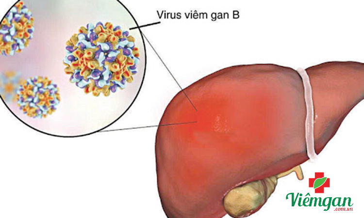 Viêm gan B thể ngủ có thể tỉnh giấc bất cứ lúc nào! 1