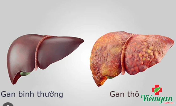 Nhu mô gan thô có phải mắc xơ gan? 1 Nhu mô gan thô có phải mắc xơ gan? 1